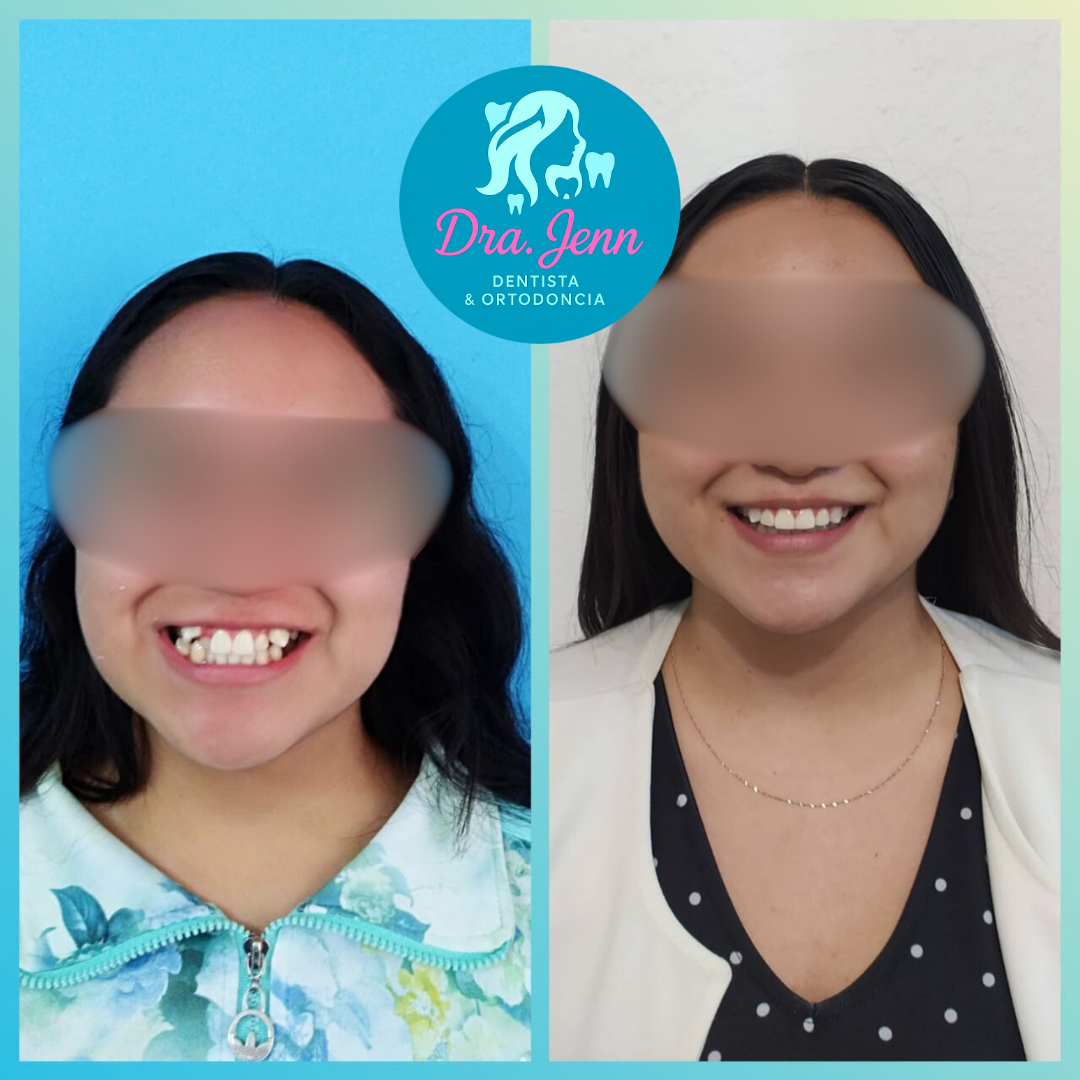 Tratamiento de brackets estéticos realizado por la Dra. Jenn
