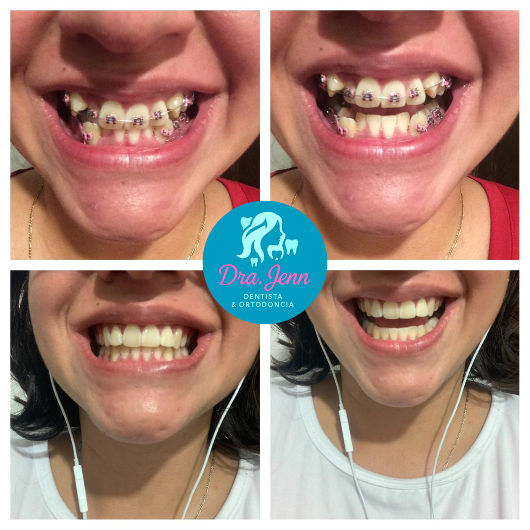 Antes y después de tratamiento de ortodoncia estética con la Dra. Jenn en CDMX