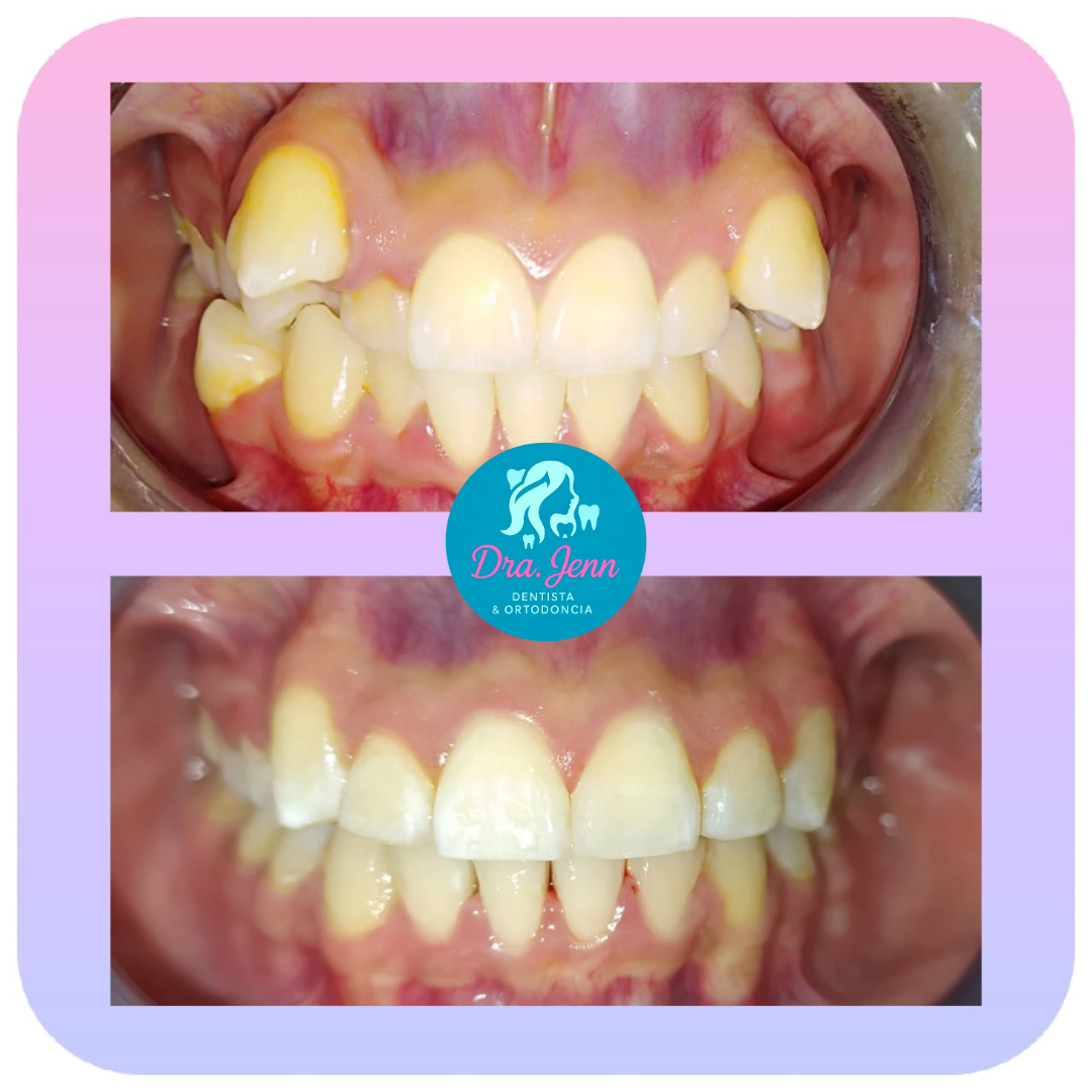 Antes y después de tratamiento de alineación dental con la Dra. Jenn en CDMX
