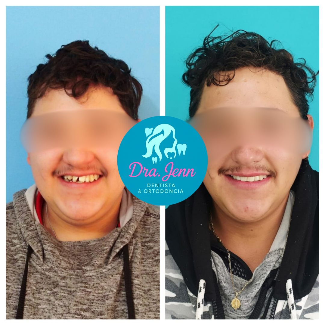 Paciente brackets estéticos Dra Jenn CDMX